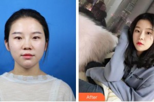 浙江大學(xué)醫(yī)學(xué)院附屬第二醫(yī)院整形科余建新整形價(jià)格表附鼻部綜合案例展示