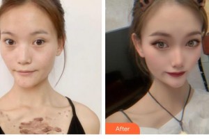 浙江省中醫(yī)院整形美容中心余土根整形價(jià)格表附微創(chuàng)疤痕修復(fù)案例展示