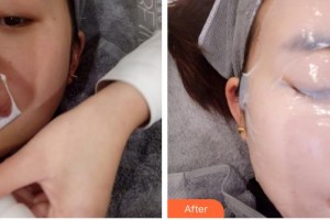 浙江省中醫(yī)院整形美容中心曹毅整形價(jià)格表附光子嫩膚案例展示