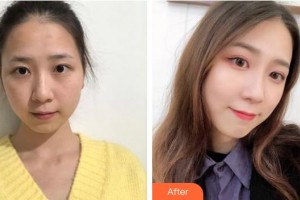 浙江省中醫(yī)院整形美容中心朱衛(wèi)菊整形價(jià)格表附超激光美膚案例展示