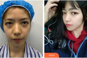 浙江省人民醫(yī)院整形外科吳華整形價(jià)格表附埋線提升案例展示