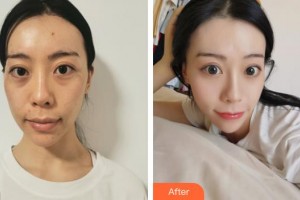 浙江衢化醫(yī)院激光整形美容中心劉利平整形價(jià)格表附埋線提升案例展示