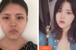 浙江衢化醫(yī)院激光整形美容中心康樂(lè)整形價(jià)格表附埋線提升案例展示