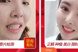 浙江大學(xué)醫(yī)學(xué)院附屬口腔醫(yī)院王慧明整形價(jià)格表附貴金屬烤瓷牙案例展示