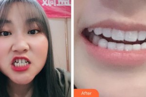 浙江大學(xué)醫(yī)學(xué)院附屬口腔醫(yī)院施潔珺整形價格表附牙貼面案例展示