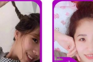 浙江大學(xué)醫(yī)學(xué)院附屬口腔醫(yī)院何福明整形價格表附牙齒隱形矯正案例展示