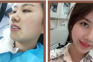 浙江大學(xué)醫(yī)學(xué)院附屬口腔醫(yī)院何虹整形價格表附美白貼片案例展示