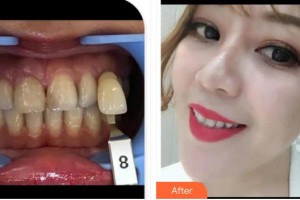 浙江大學(xué)醫(yī)學(xué)院附屬口腔醫(yī)院張凱整形價格表附冷光美白案例展示