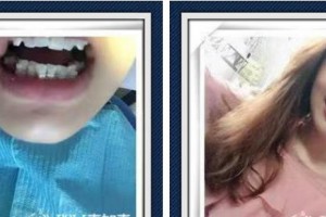 浙江大學(xué)醫(yī)學(xué)院附屬口腔醫(yī)院鄧淑麗整形價格表附牙齒隱形矯正案例展示