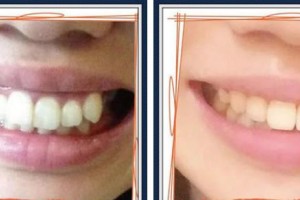 浙江大學(xué)醫(yī)學(xué)院附屬口腔醫(yī)院劉蔚整形價格表附牙齒隱形矯正案例展示