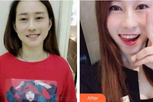 浙江大學(xué)醫(yī)學(xué)院附屬口腔醫(yī)院李曉軍整形價格表附牙齒隱形矯正案例展示