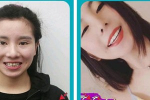 浙江大學(xué)醫(yī)學(xué)院附屬口腔醫(yī)院李志勇整形價格表附美白貼片案例展示