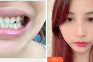 浙江大學(xué)醫(yī)學(xué)院附屬口腔醫(yī)院樊立潔整形價格表附牙齒隱形矯正案例展示