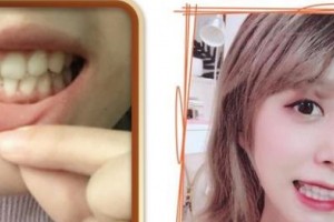 浙江大學(xué)醫(yī)學(xué)院附屬口腔醫(yī)院陳學(xué)鵬整形價格表附牙齒隱形矯正案例展示