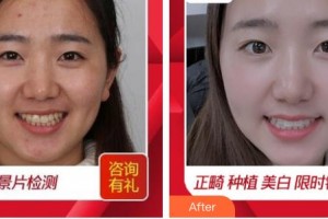 浙江大學(xué)醫(yī)學(xué)院附屬口腔醫(yī)院朱赴東整形價格表附冷光美白案例展示