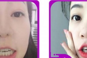 浙江大學(xué)醫(yī)學(xué)院附屬口腔醫(yī)院何建芳整形價格表附牙齒隱形矯正案例展示