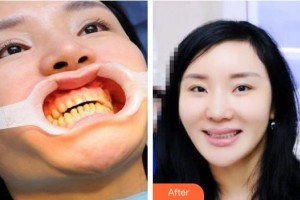 浙江大學(xué)醫(yī)學(xué)院附屬口腔醫(yī)院徐學(xué)軍整形價格表附金屬托槽矯正案例展示