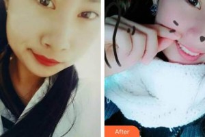 浙江大學(xué)醫(yī)學(xué)院附屬口腔醫(yī)院趙鵑整形價格表附牙綜合案例展示