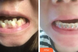 浙江大學(xué)醫(yī)學(xué)院附屬口腔醫(yī)院孫平整形價格表附金屬托槽矯正案例展示