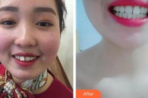 浙江大學(xué)醫(yī)學(xué)院附屬口腔醫(yī)院陳水易整形價格表附牙齒隱形矯正案例展示