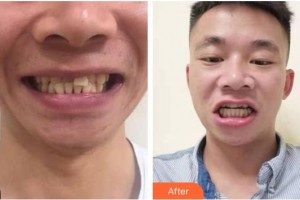 浙江大學(xué)醫(yī)學(xué)院附屬口腔醫(yī)院屠彥整形價格表附牙齒隱形矯正案例展示