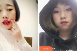 浙江大學(xué)醫(yī)學(xué)院附屬口腔醫(yī)院江巧紅整形價格表附牙齒根管調(diào)節(jié)案例展示