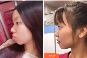 浙江大學(xué)醫(yī)學(xué)院附屬口腔醫(yī)院周藝群整形價格表附金屬托槽矯正案例展示