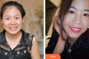 浙江大學(xué)醫(yī)學(xué)院附屬口腔醫(yī)院徐波整形價格表附自鎖托槽矯正案例展示