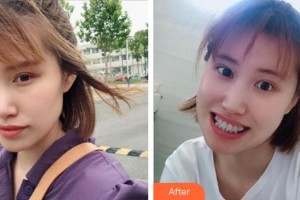 浙江大學(xué)醫(yī)學(xué)院附屬口腔醫(yī)院李文整形價格表附金屬托槽矯正案例展示