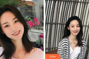 浙江大學(xué)醫(yī)學(xué)院附屬口腔醫(yī)院劉嘯晨整形價格表附金屬托槽矯正案例展示