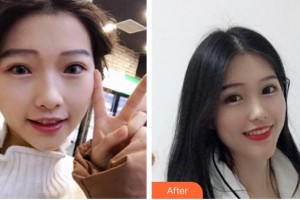 浙江大學(xué)醫(yī)學(xué)院附屬口腔醫(yī)院丁王輝整形價(jià)格表附牙齒隱形矯正案例展示