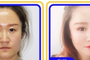 浙江大學(xué)醫(yī)學(xué)院附屬第四醫(yī)院整形美容科吳黎紅整形價(jià)格表附眼部綜合案例展示