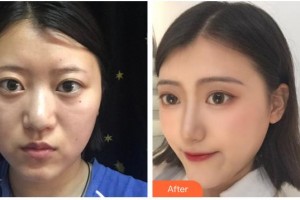 杭州華山連天美醫(yī)療美容整形醫(yī)院冷奎仿整形價(jià)格表附鼻部綜合案例展示