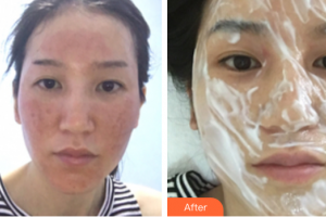 廣州海峽醫(yī)學(xué)整形美容醫(yī)院周紅英整形價(jià)格表附點(diǎn)陣激光祛痘印案例展示