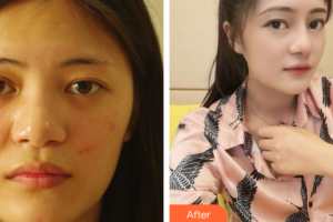 廣州軍區(qū)武漢總醫(yī)院醫(yī)學(xué)整形美容中心徐凱整形價(jià)格表附自體肋骨隆鼻案例展示