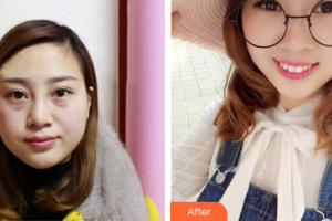 廣州拜博醫(yī)療美容門診部麥凱欣整形價(jià)格表附激光祛斑案例展示