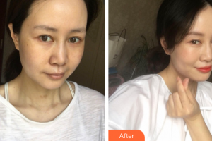 廣州美侖醫(yī)療美容門診部楊曉英整形價(jià)格表附超激光美膚祛斑案例展示