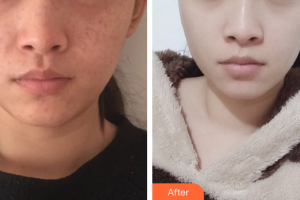 廣州美瑞兒醫(yī)療美容門診部郭昱整形價(jià)格表附祛斑祛痣案例展示