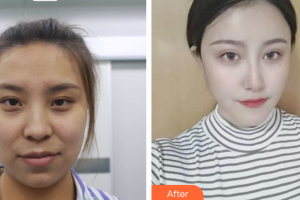 廣州壹加壹美容醫(yī)院李明整形價(jià)格表附面部吸脂案例展示