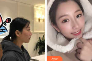 廣州凱美達(dá)整形美容醫(yī)院陽海斌整形價(jià)格表附耳軟骨鼻部手術(shù)案例展示