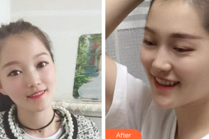 廣州圣貝口腔門診部武玉海整形價(jià)格表附金屬托槽矯正案例展示