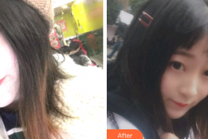 廣州圣貝口腔門診部詹春華整形價(jià)格表附金屬托槽矯正案例展示