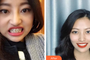 廣州圣貝口腔門診部趙艷明整形價(jià)格表附牙齒矯正案例展示