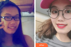 廣州圣貝口腔門診部楊妙芬整形價(jià)格表附牙齒矯正案例展示