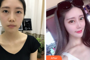 廣州弘基醫(yī)療美容門診部金敏碩整形價(jià)格表附膨體墊下巴案例展示