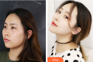 廣州博仕整形美容醫(yī)院李帥敏整形價(jià)格表附創(chuàng)可貼面部吸脂瘦臉術(shù)案例展示