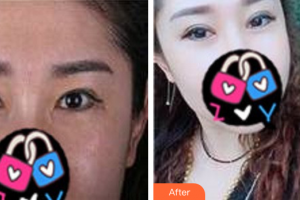 廣州圣諾達(dá)醫(yī)療美容門診部周豐整形價(jià)格表附重臉術(shù)修復(fù)案例展示