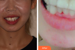 廣州圣貝口腔門診部張婉瑜整形價(jià)格表附牙齒隱形矯正案例展示