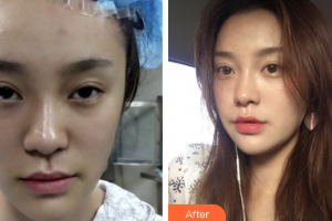 廣州圣諾達(dá)醫(yī)療美容門診部吳偉航整形價(jià)格表附埋線提升案例展示