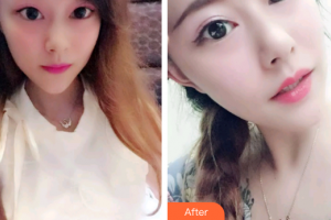 廣州穗華口腔醫(yī)院馬淑媛整形價(jià)格表附牙齒瓷貼面案例展示